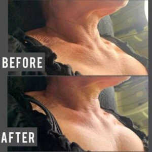 Before and after Body Sculpting at Petra's Weight Loss Clinic in Oklahoma City