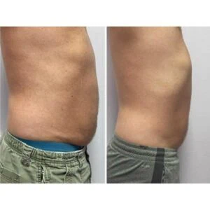 Before and after Body Sculpting at Petra's Weight Loss Clinic in Oklahoma City