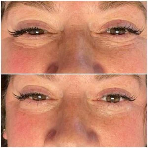 Before and after Vevazz Laser Lipo at Petra's Weight Loss Clinic in Oklahoma City