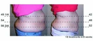 Before and after Vevazz Laser Lipo at Petra's Weight Loss Clinic in Oklahoma City