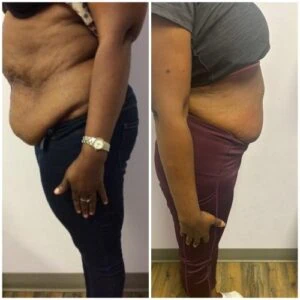 Before and after Fat Freezing at Petra's Weight Loss Clinic in Oklahoma City