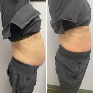 Before and after Body Shape at Petra's Weight Loss Clinic in Oklahoma City