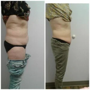 Before and after Body Sculpting at Petra's Weight Loss Clinic in Oklahoma City