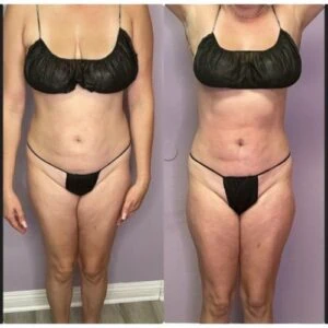 Before and after Ice Sculpting at Petra's Weight Loss Clinic in Oklahoma City