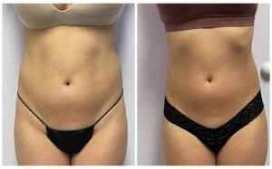 Before and after Body Sculpting at Petra's Weight Loss Clinic in Oklahoma City