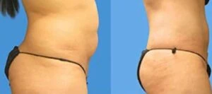 Before and after Liposlim at Petra's Weight Loss Clinic in Oklahoma City