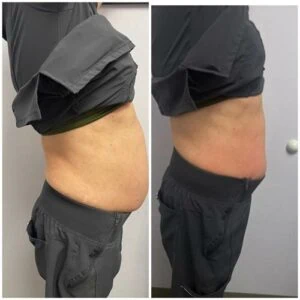 Before and after Body Shape at Petra's Weight Loss Clinic in Oklahoma City
