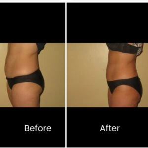 Before and after Body Shape at Petra's Weight Loss Clinic in Oklahoma City