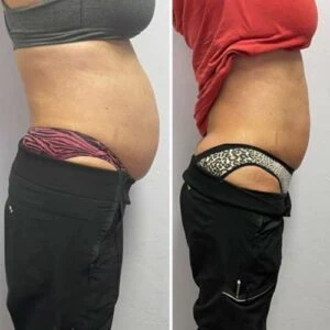 Before and after Body Sculpting at Petra's Weight Loss Clinic in Oklahoma City
