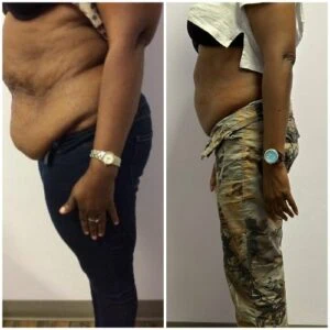 Before and after Fat Freezing at Petra's Weight Loss Clinic in Oklahoma City