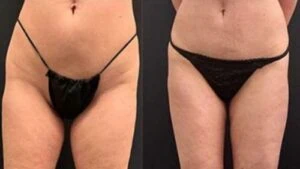 Before and after Liposlim at Petra's Weight Loss Clinic in Oklahoma City