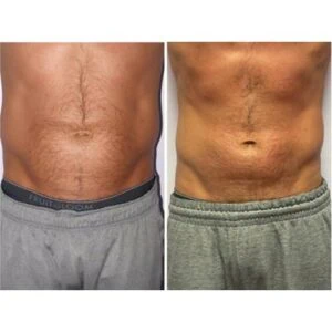 Before and after Body Sculpting at Petra's Weight Loss Clinic in Oklahoma City