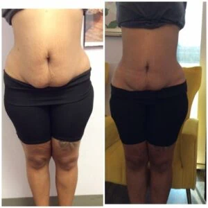 Before and after Vevazz Laser Lipo at Petra's Weight Loss Clinic in Oklahoma City