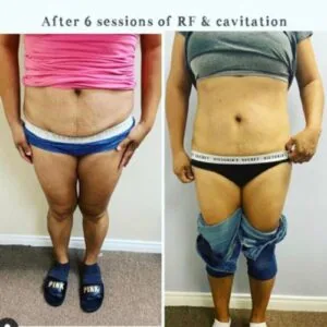 Before and after Body Sculpting at Petra's Weight Loss Clinic in Oklahoma City