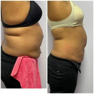 Before and after Body Sculpting at Petra's Weight Loss Clinic in Oklahoma City