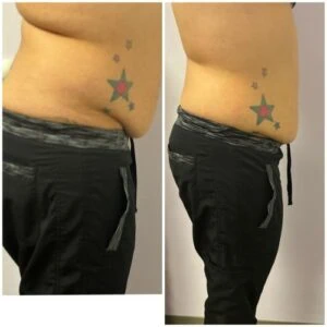 Before and after Fat Freezing at Petra's Weight Loss Clinic in Oklahoma City