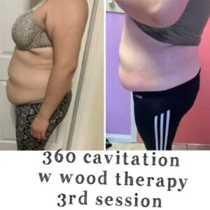Before and after Body Sculpting at Petra's Weight Loss Clinic in Oklahoma City