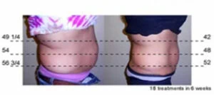 Before and after Vevazz Laser Lipo at Petra's Weight Loss Clinic in Oklahoma City