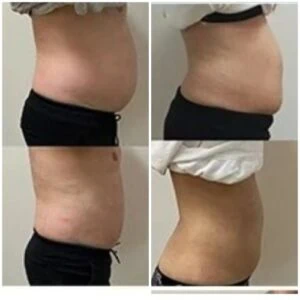 Before and after Body Sculpting at Petra's Weight Loss Clinic in Oklahoma City