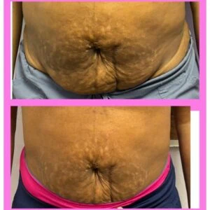 Before and after Body Sculpting at Petra's Weight Loss Clinic in Oklahoma City