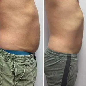 Before and after Vevazz Laser Lipo at Petra's Weight Loss Clinic in Oklahoma City