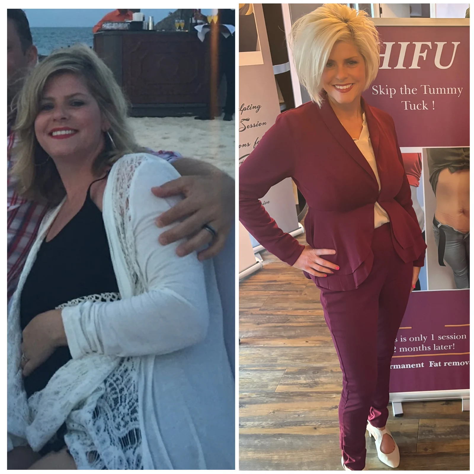 Before and after Dr. Petra Whisenhunt's 78-pound weight-loss journey