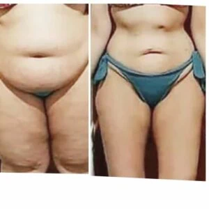 Before and after Ice Sculpting at Petra's Weight Loss Clinic in Oklahoma City