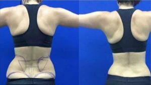 Before and after Liposlim at Petra's Weight Loss Clinic in Oklahoma City