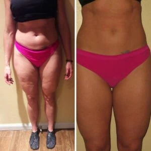 Before and after Vevazz Laser Lipo at Petra's Weight Loss Clinic in Oklahoma City