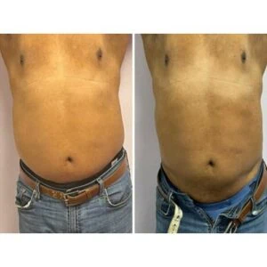 Before and after Body Sculpting at Petra's Weight Loss Clinic in Oklahoma City