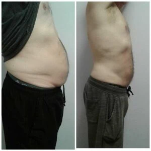 Before and after Body Sculpting at Petra's Weight Loss Clinic in Oklahoma City