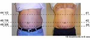 Before and after Vevazz Laser Lipo at Petra's Weight Loss Clinic in Oklahoma City