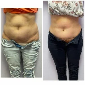 Before and after Body Sculpting at Petra's Weight Loss Clinic in Oklahoma City
