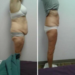 Before and after Body Sculpting at Petra's Weight Loss Clinic in Oklahoma City