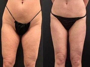 Before and after Liposlim at Petra's Weight Loss Clinic in Oklahoma City