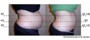 Before and after Vevazz Laser Lipo at Petra's Weight Loss Clinic in Oklahoma City