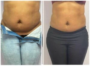 Before and after Body Sculpting at Petra's Weight Loss Clinic in Oklahoma City